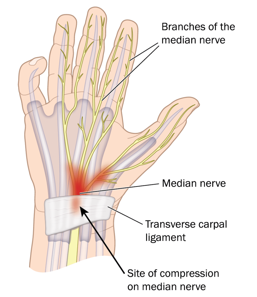 Compression in median nerve
